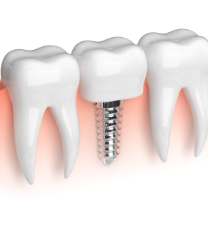 dental implant